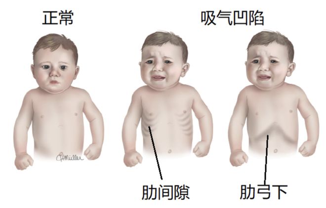 米乐M6 米乐比二阳更凶险！这两种传染病近期高发孩子有这 5 个症状赶紧就医(图6)